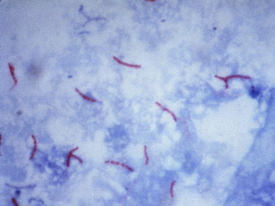  Fotografia microscópica mostra a<EM> Mycobacterium tuberculosis</EM> (em vermelho), causadora da tuberculose 