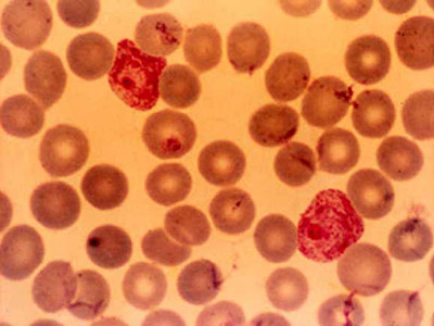  Os círculos marrons representam hemácias, as que apresentam pequenos pontos vermelhos estão infectadas com o <EM>Plasmodium vivax</EM> 