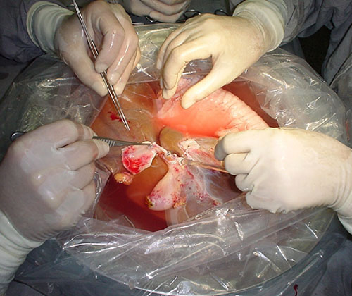  O fígado doador, após ter sido retirado, é preparado numa mesa auxiliar, sempre mergulhado numa solução de preservação gelada (Foto: Pró-Fígado) 