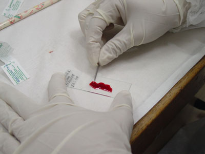  Pesquisadores fazem teste da gota espessa para diagnosticar filariose em Olinda 
