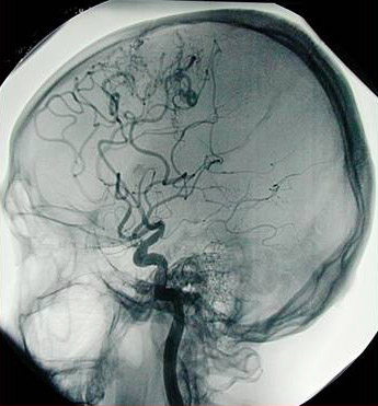  Angiografia cerebral que indica ausência de fluxo sanguíneo cerebral (Foto: <EM>site</EM> Anestesiologia) 