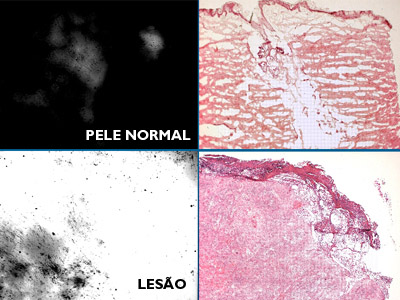  Ensaio de zimografia <EM>in situ</EM> mostrando a diferença entre a atividade das gelatinoses na pele normal comparada à lesão de LTA (Foto: Laboratório de Imunopatologia) 
