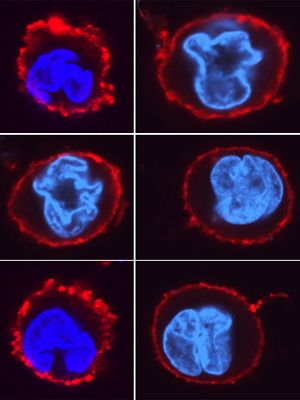  Microvesículas são liberadas da membrana dos monócitos após contato com formas infectivas do <EM>T.cruzi</EM>, auxiliando o processo de infecção do parasita. A imagem mostra os monócitos THP-1 corados com DAPI(núcleo em azul) e PKH-26 (membrana em vermelho) 
