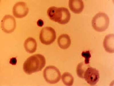  Círculos em abóbora representam hemácias (células vermelhas do sangue): aquelas com pequenos pontos escuros estão infectadas por <EM>Plasmodium</EM> 