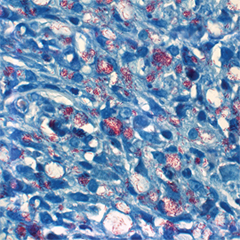 Imagem de inflamação dermatológica de <EM>Mycobacterium leprae</EM> que está na capa das <STRONG>Memórias</STRONG> 