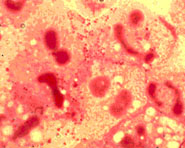 Validada técnica que reconhece bactéria causadora da meningite epidêmica