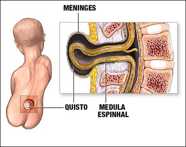  A mielomeningocele é uma malformação congênita da coluna vertebral da criança, dificultando a função primordial de proteção da medula espinhal (Arte: Instituto Nacional de Saúde/EUA) 