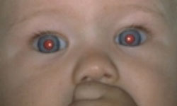  Criança com reflexo vermelho normal nos olhos, mostrando ausência de catarata 