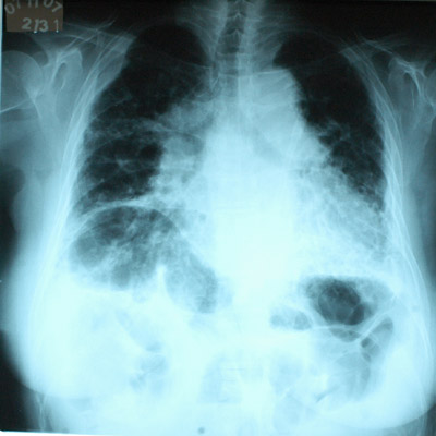  Imagem de pulmão de paciente com asbestose, uma das doenças causadas pelo amianto 
